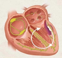 Bệnh thấp tim ở trẻ nhỏ